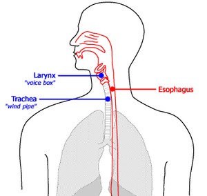 laryngitis diagram